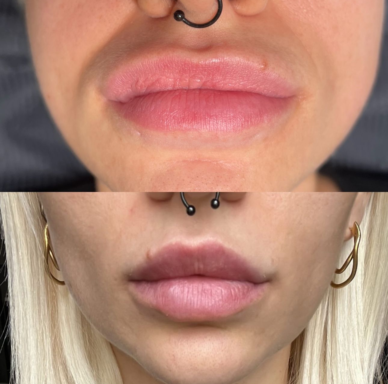 Naturalny kształt ust po precyzyjnej korekcie migracji w gabinecie Flawless